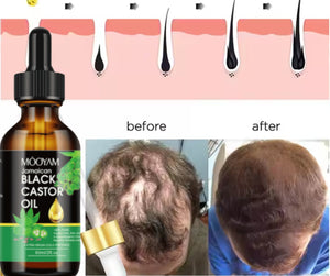 Mooyam – Huile Naturelle Anti-Calvitie & Repousse Rapide des Cheveux