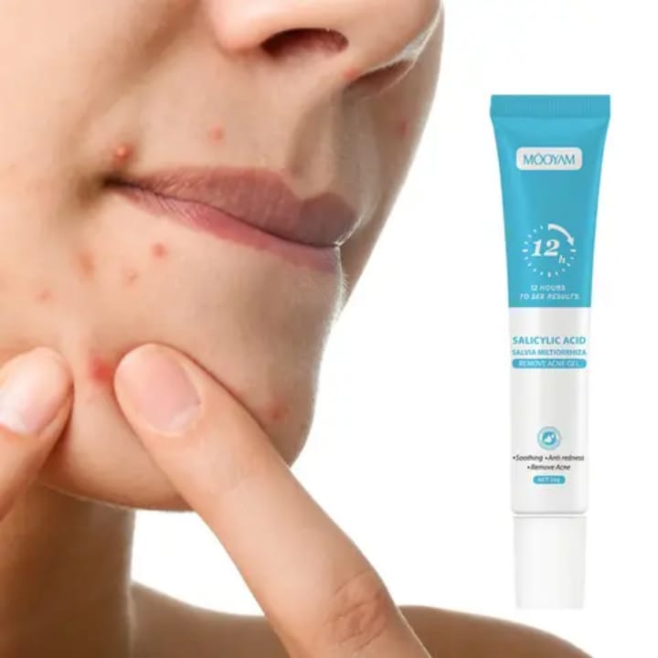 Crème Anti-Acné MOOYAM